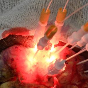 治療中レーザーの光源を腫瘍に刺している