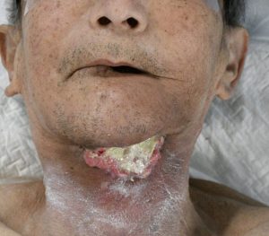 治療後1カ月腫瘍はほぼ消失